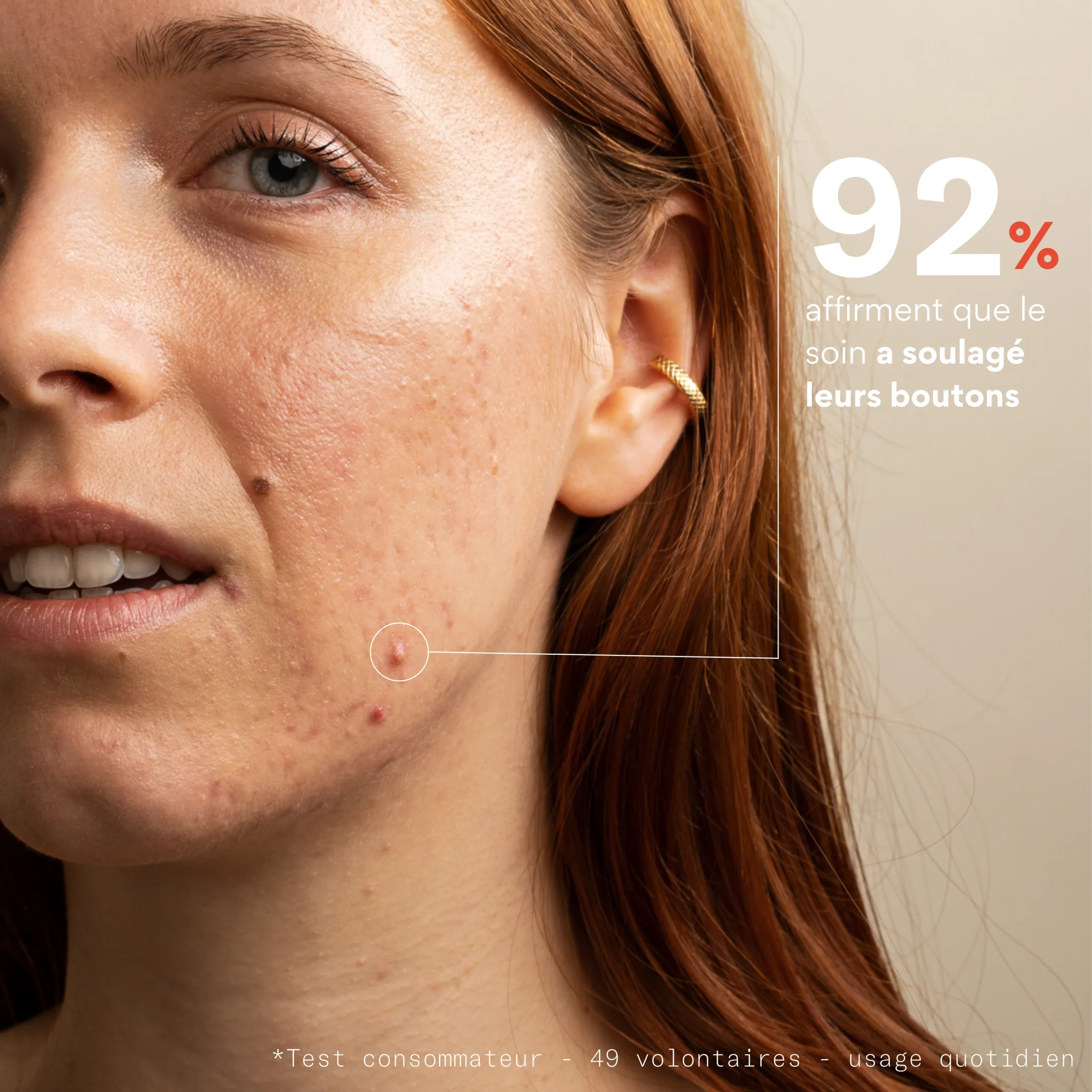 Soin anti-boutons aux prébiotiques - SKIN & OUT – Image 6