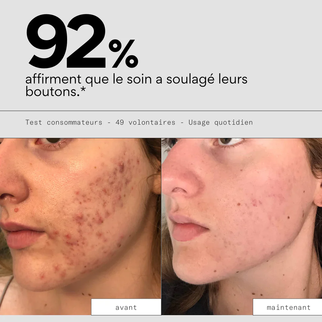 Soin anti-boutons aux prébiotiques - SKIN & OUT – Image 3